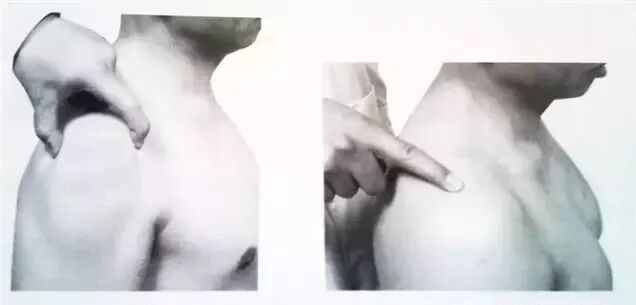 外展枕怎么使用总结的很全的针刀治疗要点，学针刀的人不容错过_https://www.jmylbn.com_新闻资讯_第17张