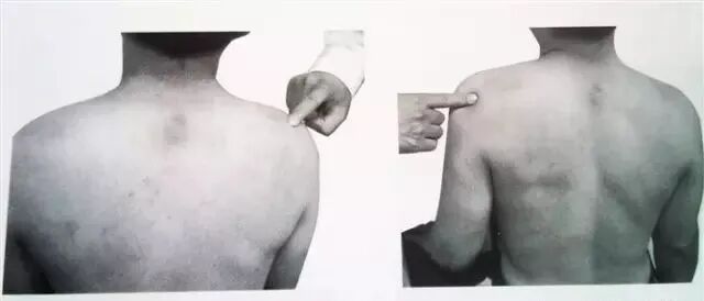 外展枕怎么使用总结的很全的针刀治疗要点，学针刀的人不容错过_https://www.jmylbn.com_新闻资讯_第18张