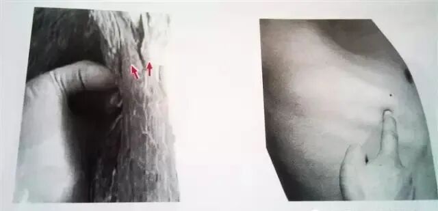 外展枕怎么使用总结的很全的针刀治疗要点，学针刀的人不容错过_https://www.jmylbn.com_新闻资讯_第26张