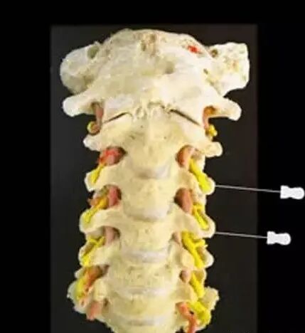 外展枕怎么使用总结的很全的针刀治疗要点，学针刀的人不容错过_https://www.jmylbn.com_新闻资讯_第10张