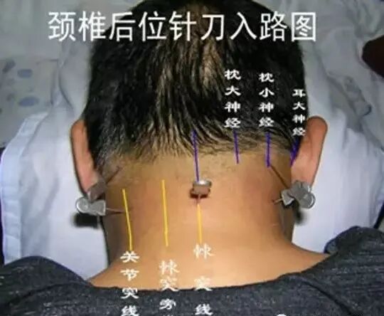 外展枕怎么使用总结的很全的针刀治疗要点，学针刀的人不容错过_https://www.jmylbn.com_新闻资讯_第6张