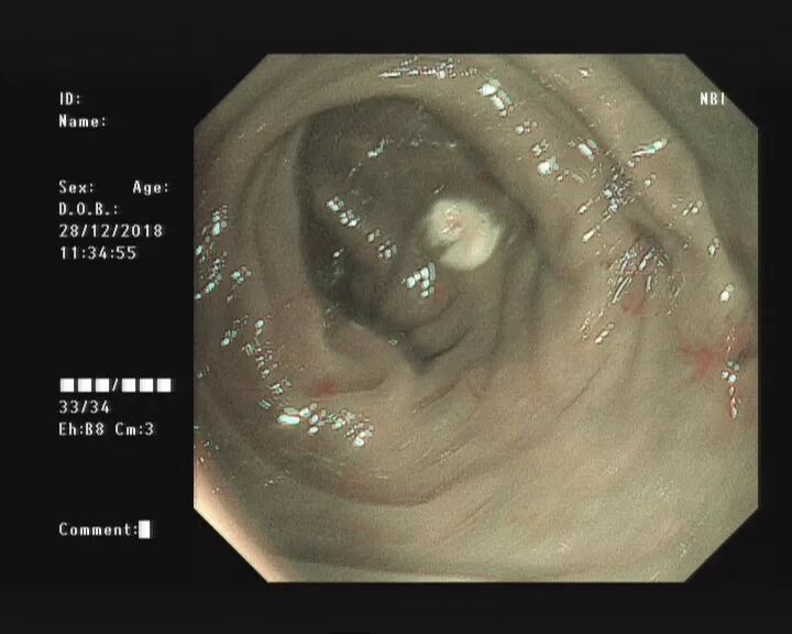 斑马导丝是治疗什么的不开刀，肠镜下治疗阑尾炎 —— ERAT_https://www.jmylbn.com_新闻资讯_第3张