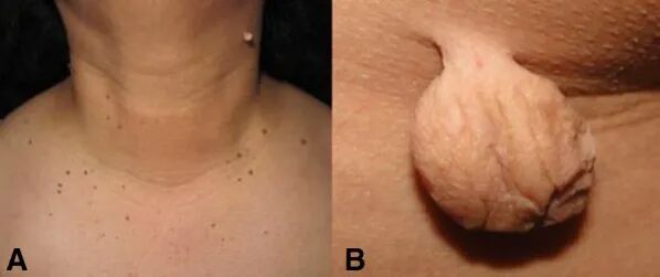 皮肤上有小肉球? | SOMADERM 凝胶调节自身分泌代谢