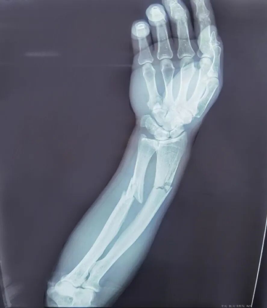 AED怎么自检手腕摔伤后自检方法及诊疗释疑_https://www.jmylbn.com_新闻资讯_第5张