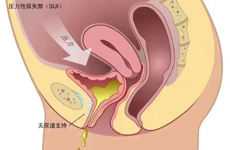 尿道张力过强怎么办京煤总医院妇产科成功实行经阴道闭孔无张力尿道中段悬吊改良术_https://www.jmylbn.com_新闻资讯_第2张