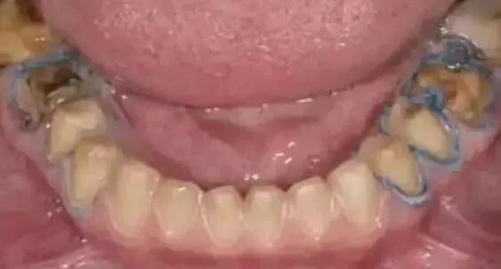 牙科材料硅胶怎么用【干货】简便式完美取模技巧（附牙体制备后双线排龈、硅橡胶取模实拍视频）_https://www.jmylbn.com_新闻资讯_第16张