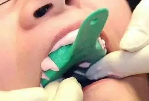 牙科材料硅胶怎么用【干货】简便式完美取模技巧（附牙体制备后双线排龈、硅橡胶取模实拍视频）_https://www.jmylbn.com_新闻资讯_第19张