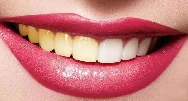 牙齿美白对牙齿有伤害吗？