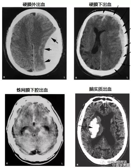 傳出或傳入神經病變時的瞳孔對光反射9.常見的作用於中樞