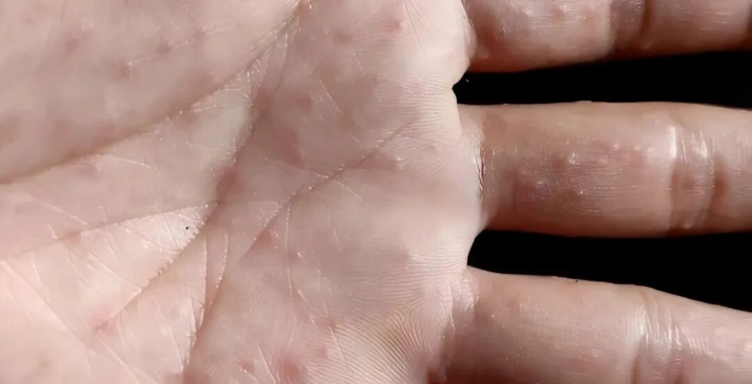 【皮肤健康】湿疹的治疗方法有哪些呢