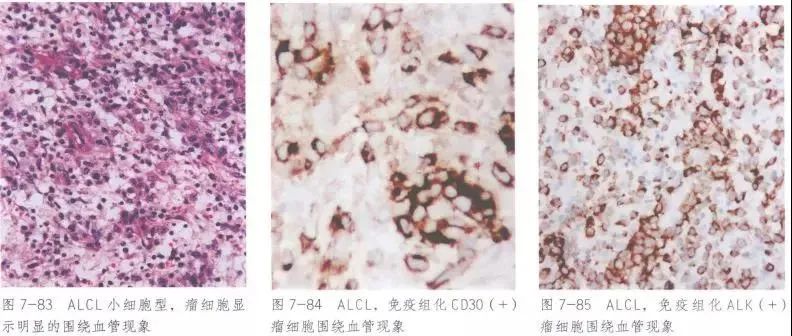 间变性大细胞淋巴瘤，alk阳性