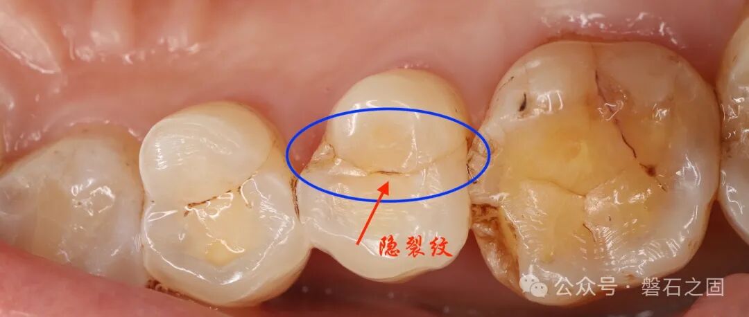 牙隐裂-河南省中医院