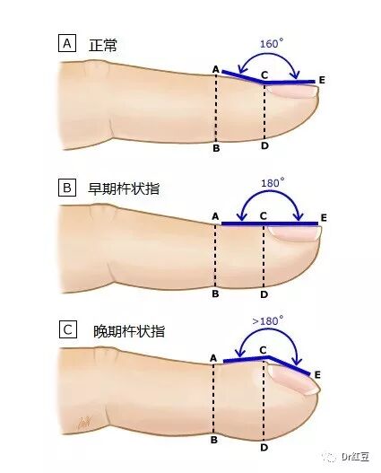 杵状指 医牛健康资讯