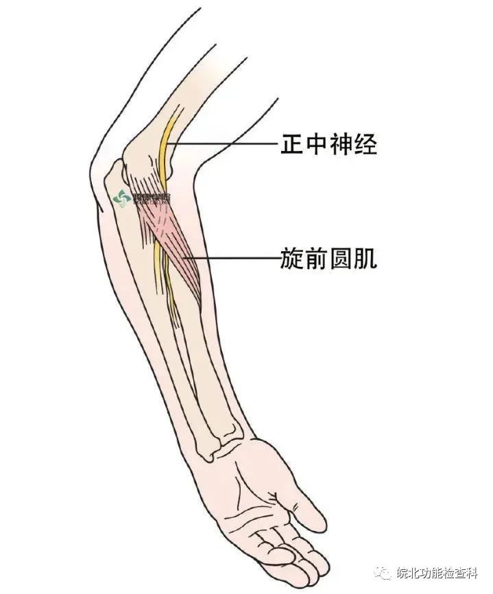 病生:旋前圆肌综合征系正中神经和前臂掌侧神经在前臂近侧受压后产生