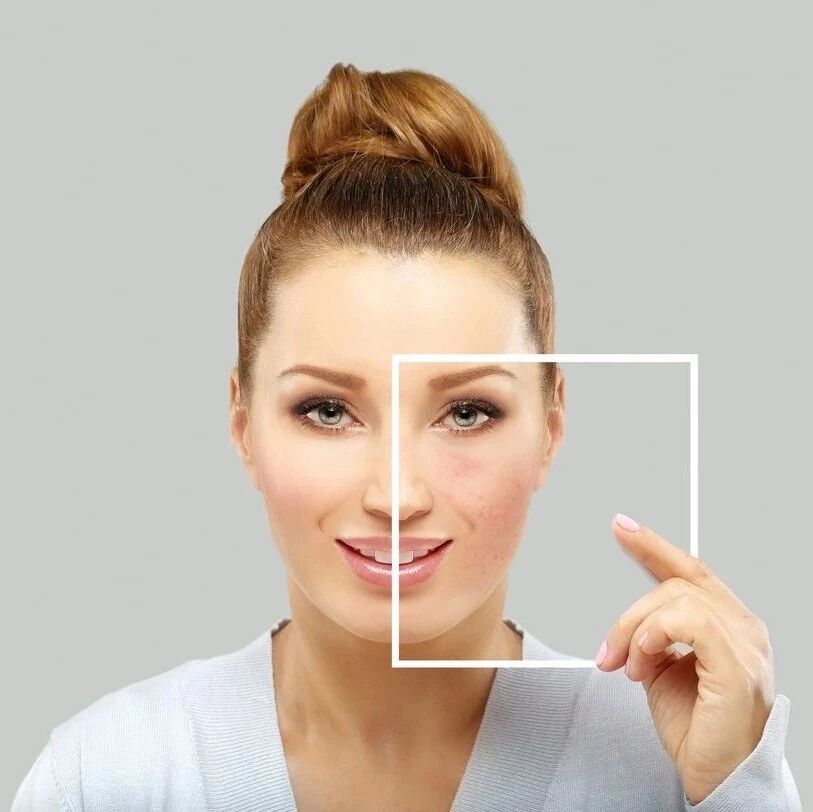 黄褐斑、咖啡斑、痘印...脸上的这些印迹怎么处理？