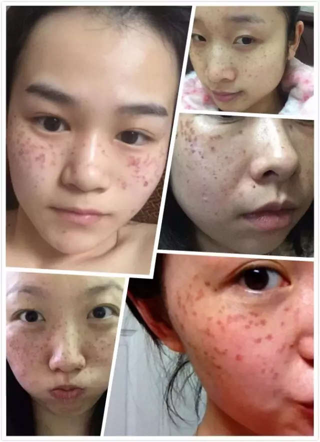 皮秒——斑斑点点,一扫而空! 皮秒——斑斑点点,一扫而空!
