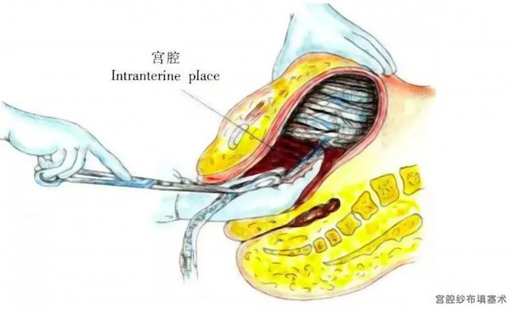 怎么放置子宫球囊支架妇产科必备技能！产后出血的6大手术治疗方式_https://www.jmylbn.com_新闻资讯_第3张