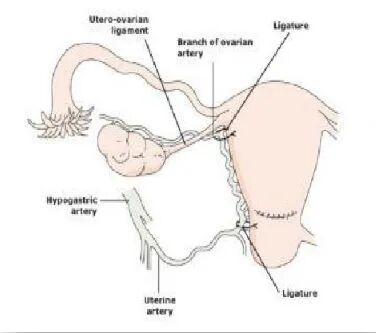 怎么放置子宫球囊支架妇产科必备技能！产后出血的6大手术治疗方式_https://www.jmylbn.com_新闻资讯_第6张