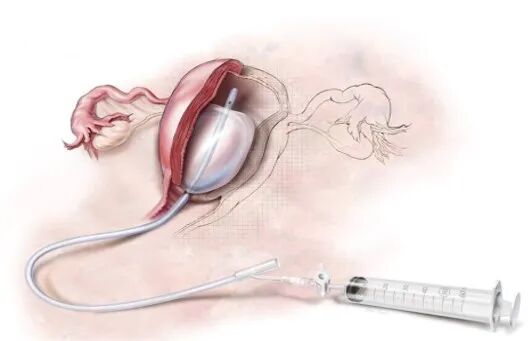 怎么放置子宫球囊支架妇产科必备技能！产后出血的6大手术治疗方式_https://www.jmylbn.com_新闻资讯_第9张