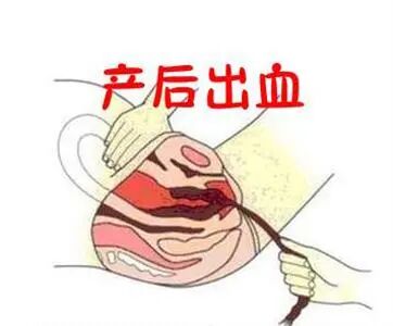 怎么放置子宫球囊支架妇产科必备技能！产后出血的6大手术治疗方式_https://www.jmylbn.com_新闻资讯_第2张