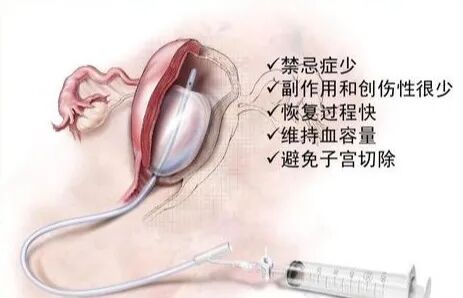 怎么放置子宫球囊支架妇产科必备技能！产后出血的6大手术治疗方式_https://www.jmylbn.com_新闻资讯_第12张