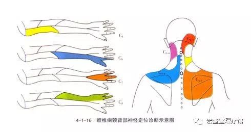 颈椎病会引起手臂酸痛麻木吗 宏盛堂理疗馆 微信公众号文章阅读 Wemp