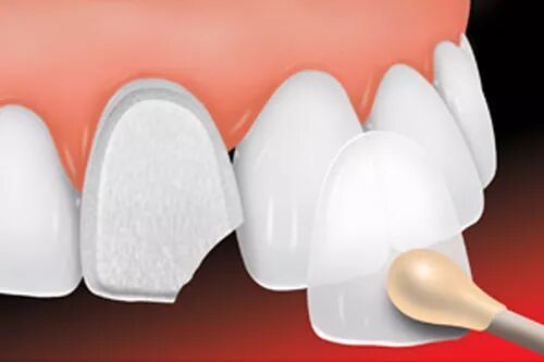 瓷贴面美学修复前牙，树脂粘接有哪些要点？