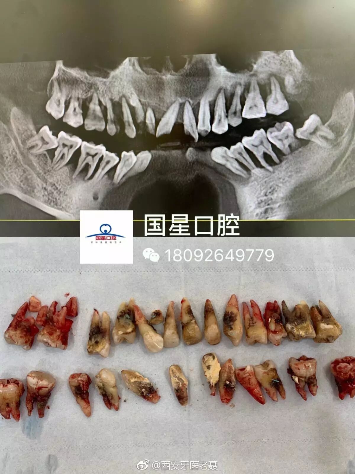 牙周炎不治疗，到最后就是这样的结果太可怕了