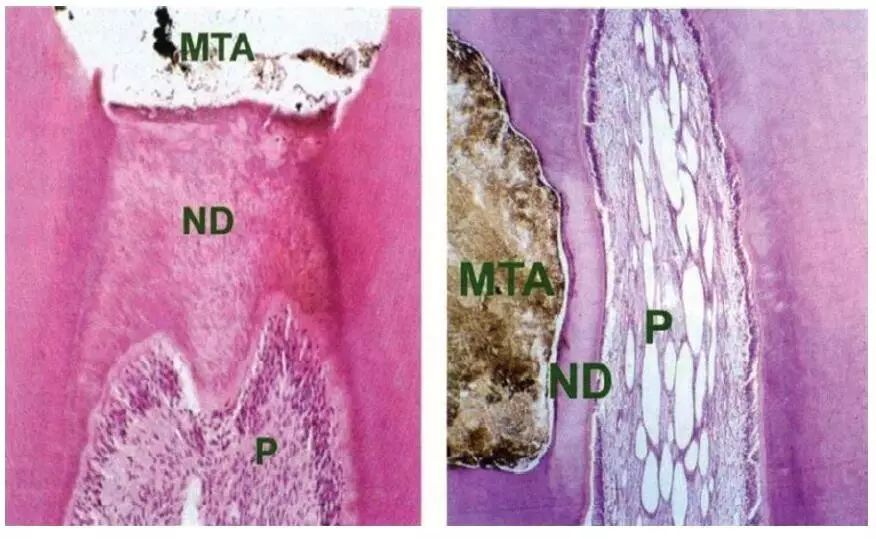蛣2 mta在活髓切断术和盖髓术中的组织表现