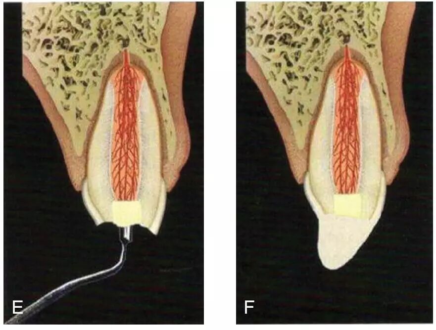 蛣2 mta在部分活髓切断术中的步骤