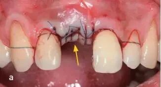 缝合针怎么选规格口腔缝合针，该怎么选择？_https://www.jmylbn.com_新闻资讯_第3张