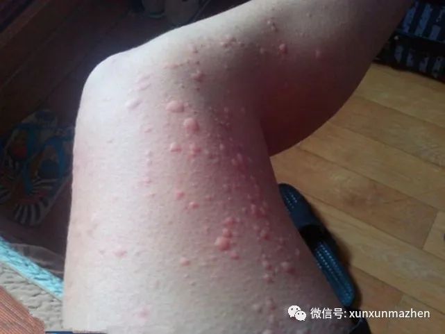 荨麻疹的饮食禁忌及治疗方法