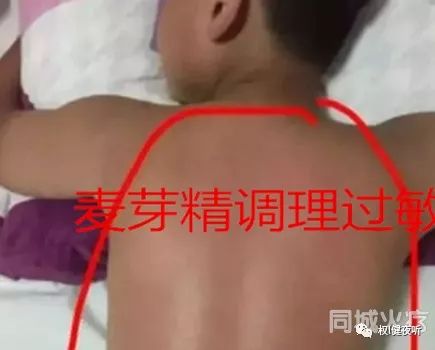 权健麦芽精调理过敏 只敷一天红疹消失 不痛不痒 权健秘方太赞了 权l健夜听 微信公众号文章阅读