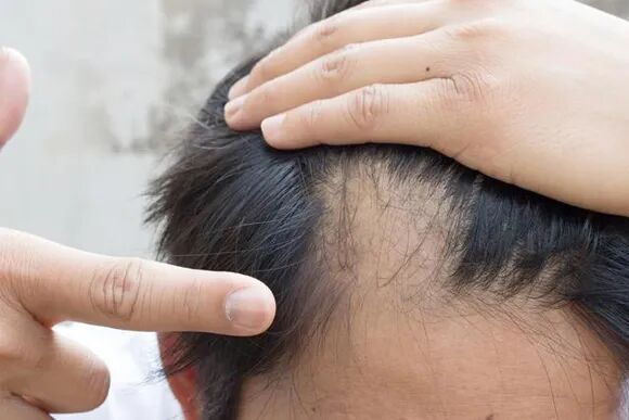 年龄不大，脱发、斑秃、发际线高？
