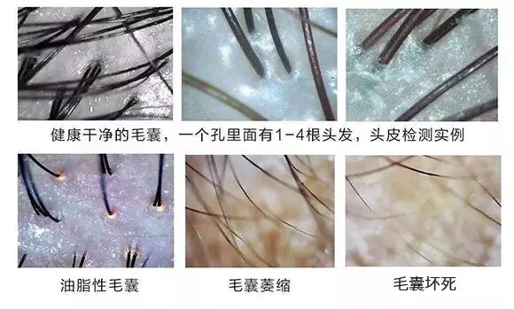 头发掉的多，毛囊还健康吗？