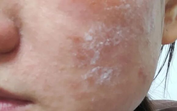 脂溢性皮炎有什么症状？