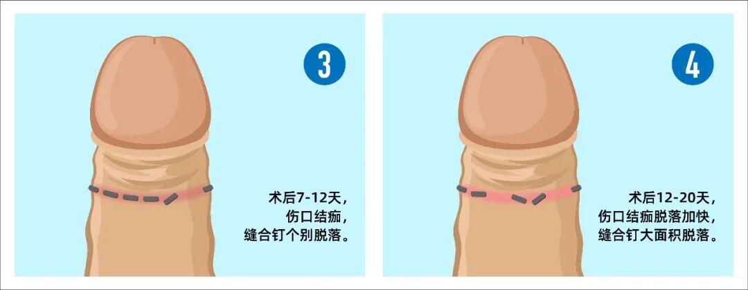 拆钉器怎么用包皮缝合器手术后如何拆钉？图文+视频为你详解！_https://www.jmylbn.com_新闻资讯_第4张