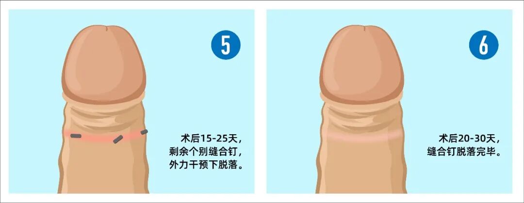 拆钉器怎么用包皮缝合器手术后如何拆钉？图文+视频为你详解！_https://www.jmylbn.com_新闻资讯_第5张