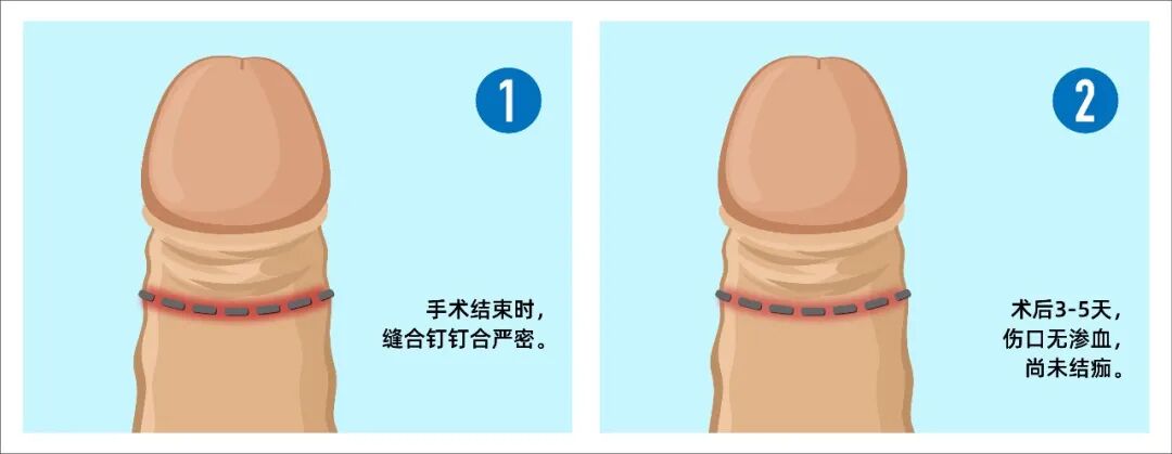 拆钉器怎么用包皮缝合器手术后如何拆钉？图文+视频为你详解！_https://www.jmylbn.com_新闻资讯_第3张