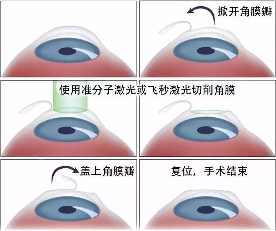 一周告別高度近視 真人記錄icl 眼部手術全過程 尋夢健康