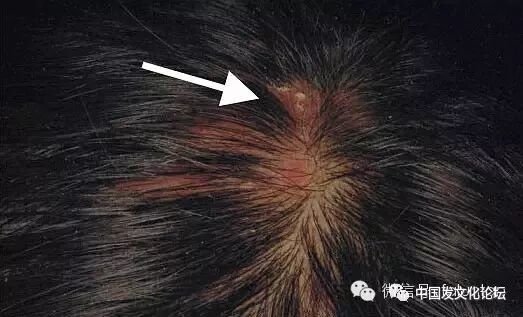 小心头皮炎症导致脱发