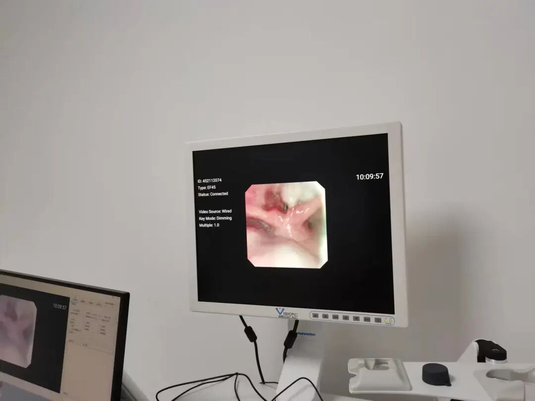 什么是电子鼻咽镜我院五官科引进高清鼻内窥镜摄像系统及电子喉镜_https://www.jmylbn.com_新闻资讯_第5张