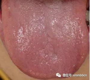 小儿推拿舌诊之舌苔辩证 厦门妈咪贝比 微信公众号文章阅读 Wemp