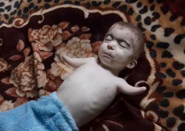 出生在切尔诺贝利禁区的两岁男童,因核辐射而先天畸形.