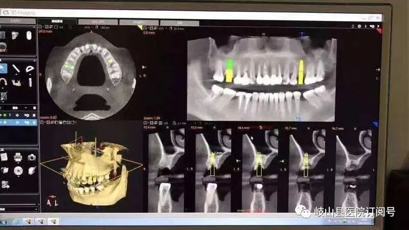数字牙片机怎么用县医院口腔科引进卡瓦X-TREND口腔三合一CBCT现代化数字检查设备_https://www.jmylbn.com_新闻资讯_第15张