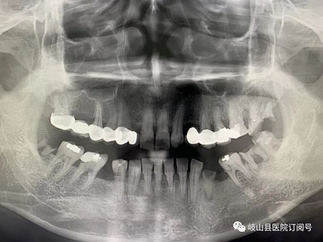 数字牙片机怎么用县医院口腔科引进卡瓦X-TREND口腔三合一CBCT现代化数字检查设备_https://www.jmylbn.com_新闻资讯_第16张
