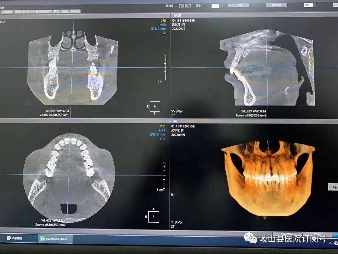 数字牙片机怎么用县医院口腔科引进卡瓦X-TREND口腔三合一CBCT现代化数字检查设备_https://www.jmylbn.com_新闻资讯_第14张