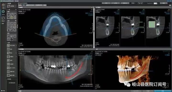 数字牙片机怎么用县医院口腔科引进卡瓦X-TREND口腔三合一CBCT现代化数字检查设备_https://www.jmylbn.com_新闻资讯_第17张