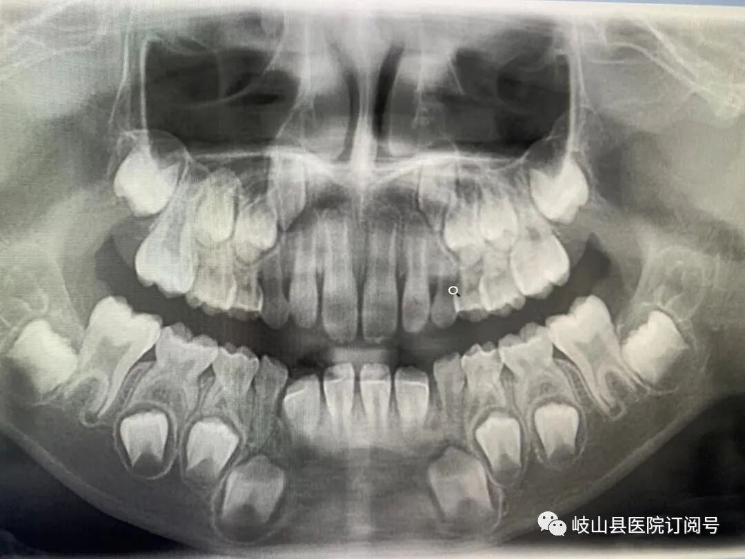 数字牙片机怎么用县医院口腔科引进卡瓦X-TREND口腔三合一CBCT现代化数字检查设备_https://www.jmylbn.com_新闻资讯_第13张