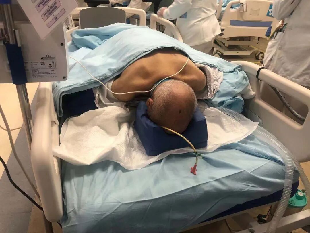 重症康复患者正在做床旁康复治疗